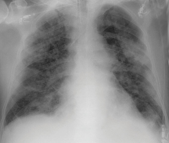 lung x-ray