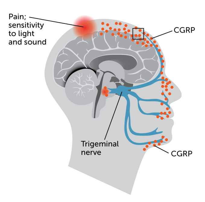 illustration of migraine events in the brain