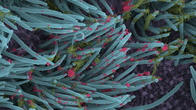 microscope image of SARS-CoV-2 infecting the lungs