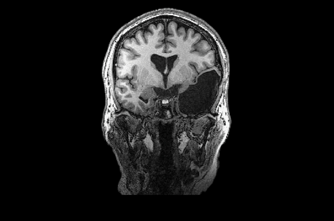 An MRI scan of Martha M.'s brain with a large dark section on the right side.